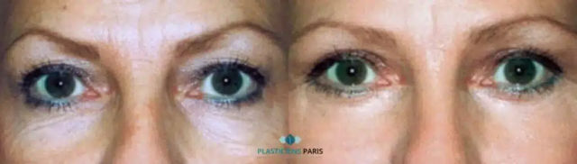 Chirurgie des paupières et lipofilling des pommettes, photos avant et après. Chirurgie des quatre paupières avec lipofilling des pommettes. Un regard résolument plus jeune après l'opération de blépharoplastie.