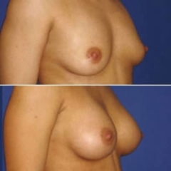 implant mammaire anatomique 320 cc haute projection résultat PROFILPatiente de 33 ans. Seins 90 B vidés après un allaitement. On pratique une chirurgie par voie axillaire (cicatrice sous l’aisselle) sous contrôle endoscopique pour la mise en place derrière le muscle d’implants anatomiques haut profil recouverts de polyuréthane POLYTECH de 320 cc. Résultat à 6 mois avec bonnet C. On notera la pente douce du décolleté donnant un aspect naturel.