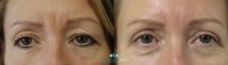 Chirurgie des paupières – Blépharoplastie Patiente de 62 ans. avant après d'une Blépharoplastie des paupières avec résection de l'excès cutané des paupières supérieures et ablation des poches graisseuses des paupières inférieures par l'intérieur de la paupière sans cicatrice (voie conjonctivale).