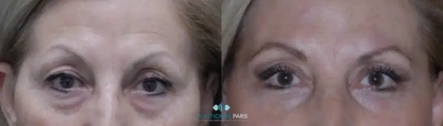 résultats avant après d'une Blépharoplastie des 4 paupières d'une femme.