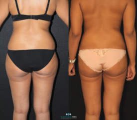 liposuccion hanches et cuisses 901