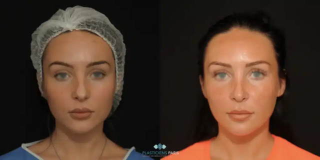 Rhinoplastie ultrasonique avec traitement de la pointe pour l’affiner et ablation de la bosse - vue de face