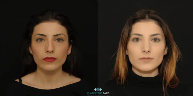 Rhinoplastie ultrasonique avec traitement de la pointe pour l’affiner et ablation de la bosse - vue de face