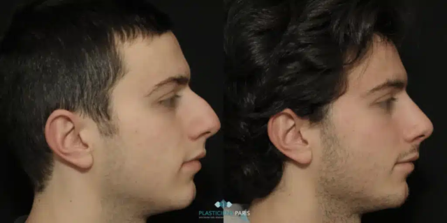 Rhinoplastie ultrasonique avec traitement de la pointe pour l’affiner et ablation de la bosse - vue de profil