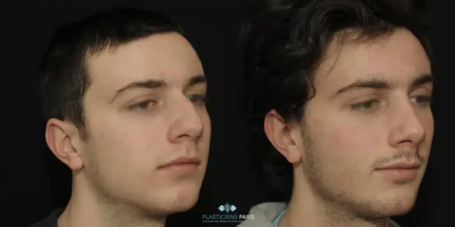 Rhinoplastie ultrasonique avec traitement de la pointe pour l’affiner et ablation de la bosse - vue de 3/4