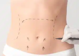 abdominoplastie