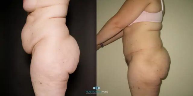 plastie abdominale haute tension avec lipoaspiration de l abdomen et des hanches